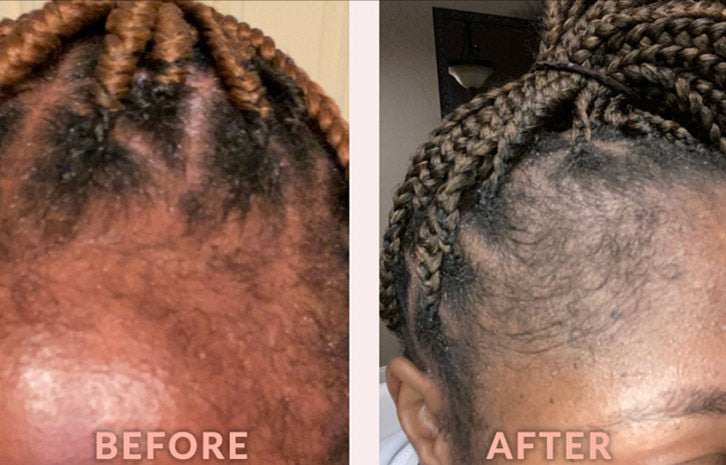 Success story using Design Essentials® Scalp Care Edge & Temple Strengthening Oil: “Hairline is improving and getting stronger”- B.Payne